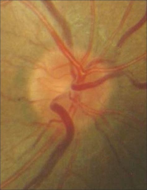 normal  optic nerve    scientific diagram