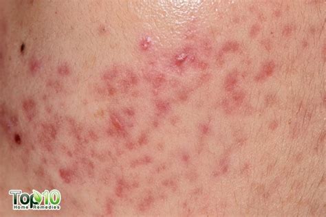 Candidiasis Skin Rash