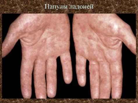 Вторичный сифилис - презентация онлайн