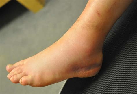 Sprained ankle symptoms, sprained ankle treatment and recovery time