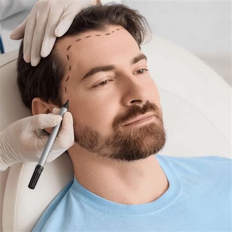 transform     turkey hair transplant  acibadem hair