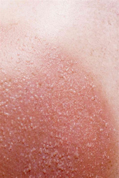 15 Common Skin Rashes in Children: Types and Causes