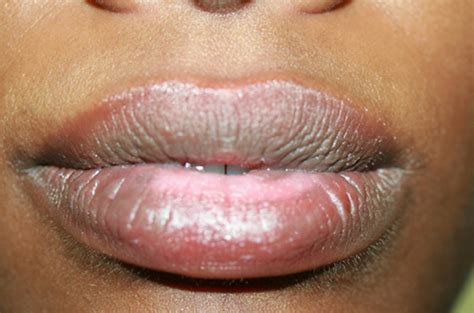 how to fix discolored lips