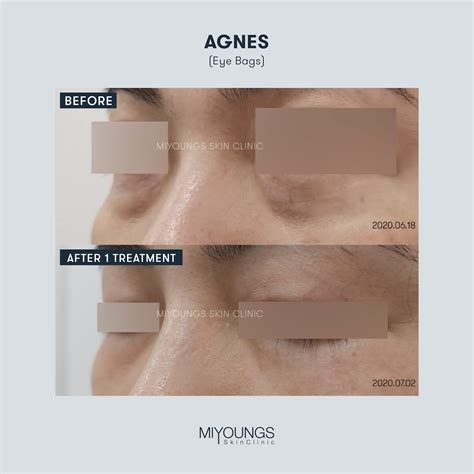 how to remove eyebags