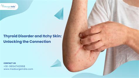 Thyroid Disorder And Itchy Skin: Unlocking The Connection