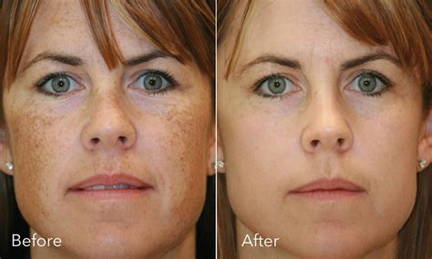 BBL Pigment Treatment - 4D Skin Clinic