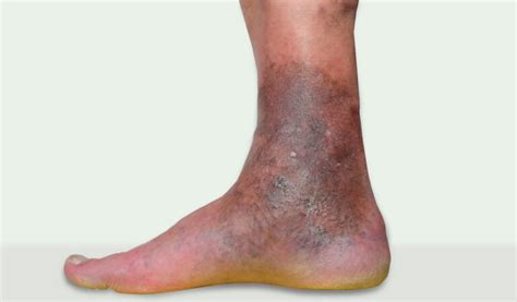 Chronic Venous Insufficiency | Grand Junction Vein Center