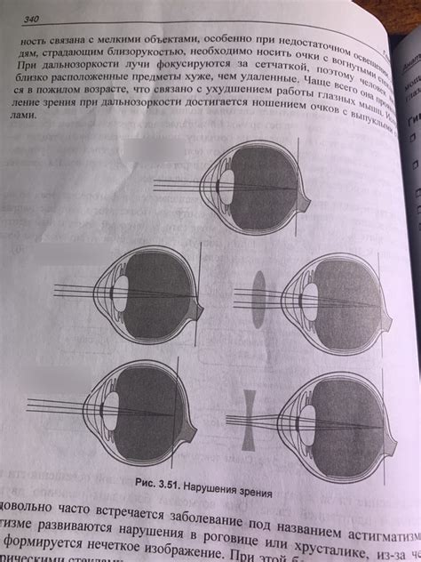 Нарушения зрения Diagram | Quizlet