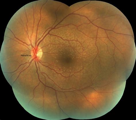 reticular drusen retinara