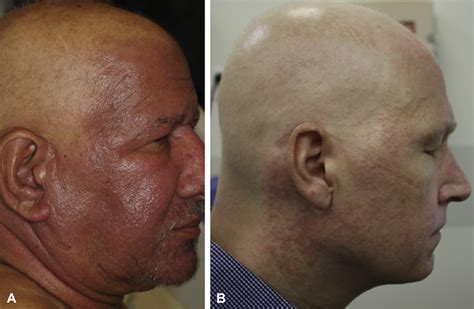 Sparing of the scalp in severe Demodex folliculitis after stem cell ...