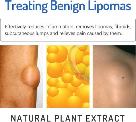 Lipoma Removal Cream, LumpFree Lipoma Removal Cream, 20g Lipoma Removal ...