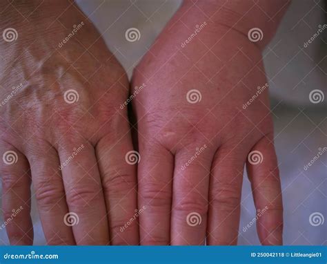 Hand Swollen after Bee Sting Allergic Reaction Close Up Stock Photo