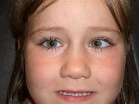 how to fix esotropia