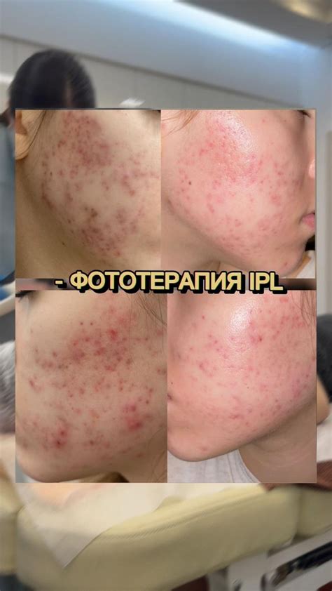 Фототерапия от постакне🔥