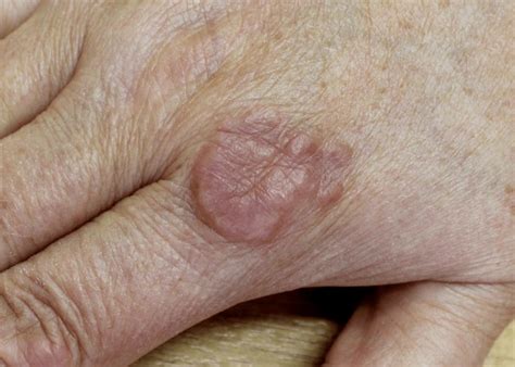 15 Annular Lesion Royalty-Free Images, Stock Photos & Pictures ...