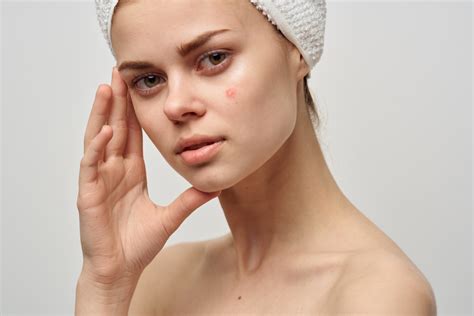 Угревая сыпь: симптомы, причины и лечение | блог Expert Clinics