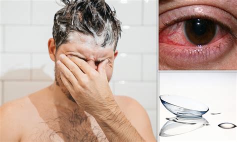 Suvo oko : Uzroci, Simptomi, Lečenje, Hirurgija, Prevencija