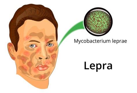 Lepra - Hansen-Krankheit - Aussatz - Miselsucht
