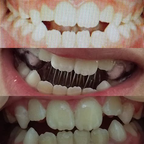 Paciente com dentadura mista, hábito de interposição lingual, mordida ...