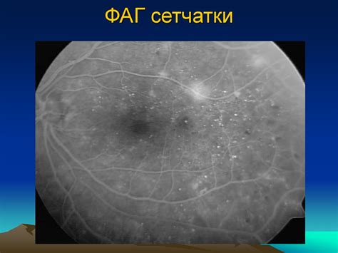 Диабетическая ретинопатия - презентация онлайн