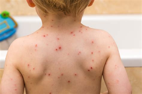 Viral Rash In Toddlers