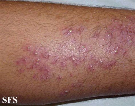 Fungal Skin Infections Rash at Dawn Moore blog