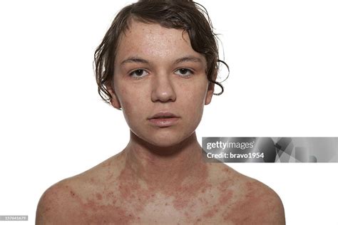 Atopic Dermatitis Stock-Foto - Getty Images