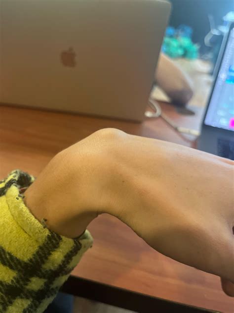 What is this lump on my wrist? : r/medical_advice
