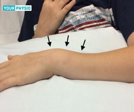 Colles Fracture: Causes, Symptoms, And Diagnosis, 51% OFF