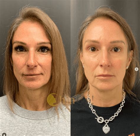Facial Fillers Before and After: Transformations, Benefits, and What to