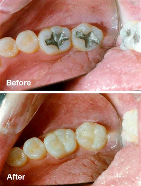 Tooth Decay Treatment Before And After
