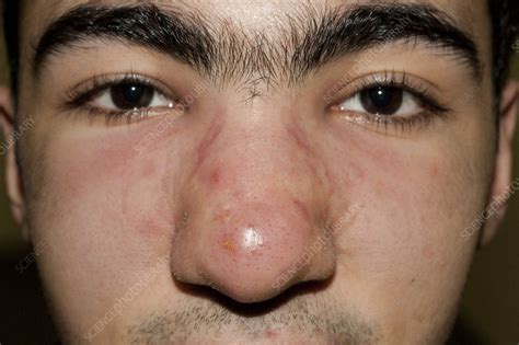 Acne Cyst Nose