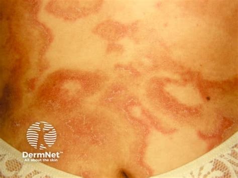 Annular erythema (erythema annulare centrifugum): Signs, Symptoms and ...