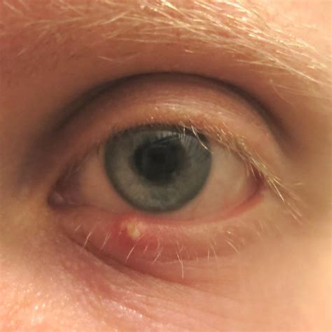 Stye, Hordeolum and Chalazion Treatment in NYC | Jimmy Hu
