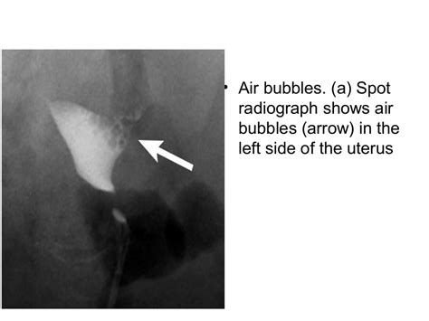 Hysterosalpingography cases