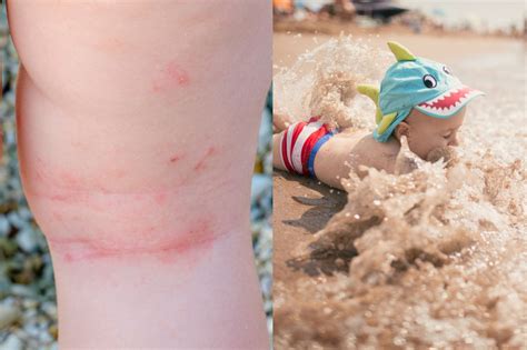 Alergia A Areia Da Praia - Crianças na praia? Saiba o que é e como evitar a dermatite do traje de ...