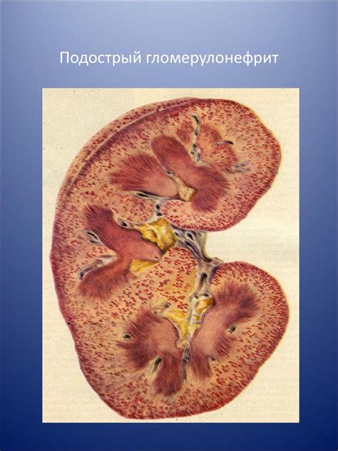 Острый гломерулонефрит - презентация онлайн