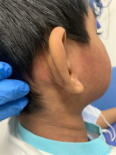 Rubella Rash Behind Ears