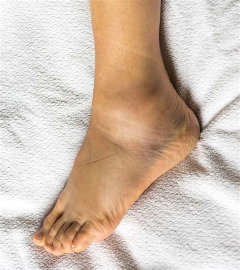edema ankle swelling