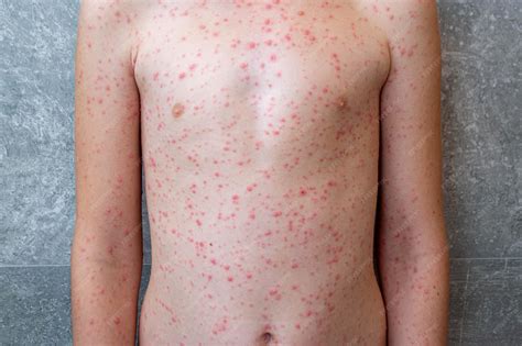 chicken pox virus