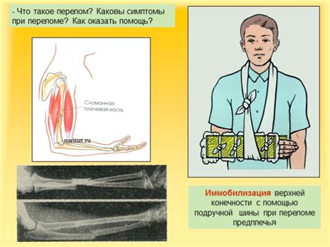 Презентация - Первая помощь при растяжении связок, вывихах суставов ...