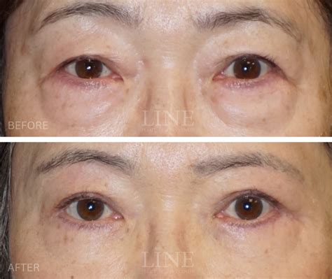 Gallery - Lower Eyelid - Line Plastic Surgery Center