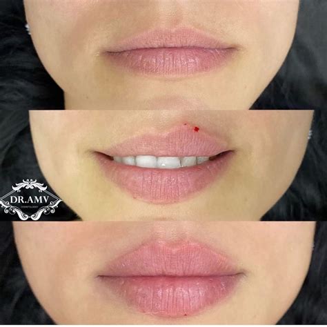 Cosmetic Insider on Instagram: “Repost from @amvclinic 👄. Have you ...
