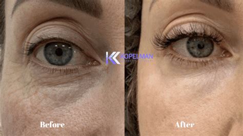 laser  eye bag removal    dr kopelman