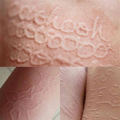 Dermatographia - MEDizzy
