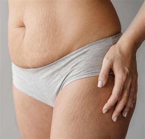End your battle with Stretch Marks: Plasma Fibroblast Treatment