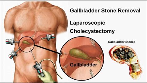 how much does it cost to remove gallbladder stones