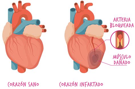 Síndrome coronario agudo | Mas Simple Argentina