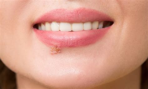 Herpes na usni: Uzrok, simptomi i lečenje groznice - Permadent