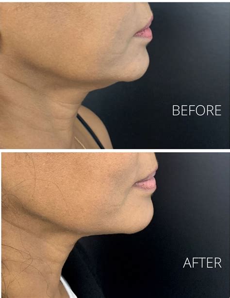 surgical jowl lift thread lift hifu injectables fillers  jowl